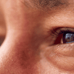 Έχετε ξηροφθαλμία; Το θρεπτικό συστατικό που μπορεί να σας λείπει