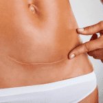 Ρεκόρ καισαρικών στην Ελλάδα Έφτασαν το 62% των γεννήσεων