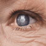 Λιγότερο κρέας, λιγότερες πιθανότητες για καταρράκτη υποστηρίζουν Βρετανοί