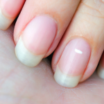 Τι προκαλεί τις λευκές κηλίδες στα νύχια