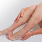 Γιατί εμφανίζονται οι κιρσοί και πότε χρειάζονται έλεγχο